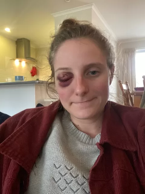 Woman with an injured eyelid